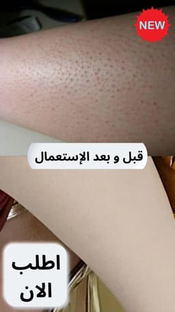 مزيل الشعر بالليزر، جهاز إزالة الشعر بالليزر المنزلي بتقنية IPL لبشرة جميلة ومشرقة 9