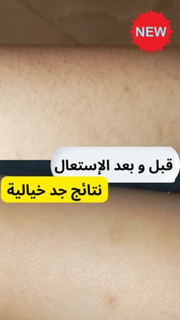 مزيل الشعر بالليزر، جهاز إزالة الشعر بالليزر المنزلي بتقنية IPL لبشرة جميلة ومشرقة 10